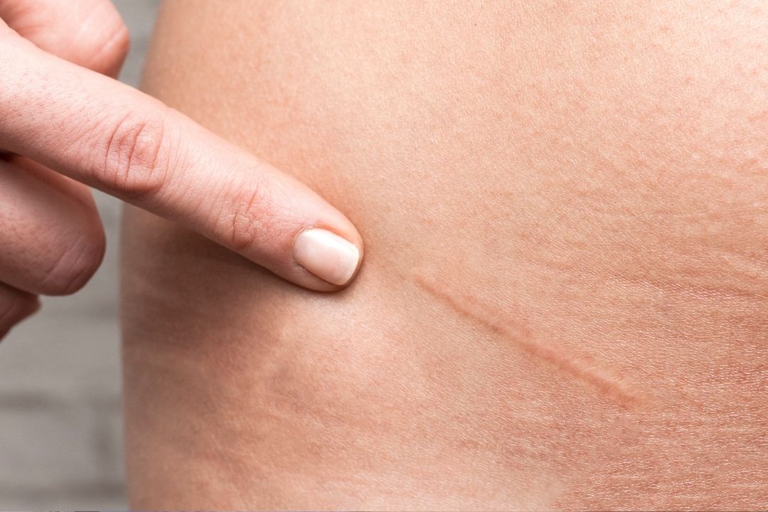 Tratamento de Cicatriz