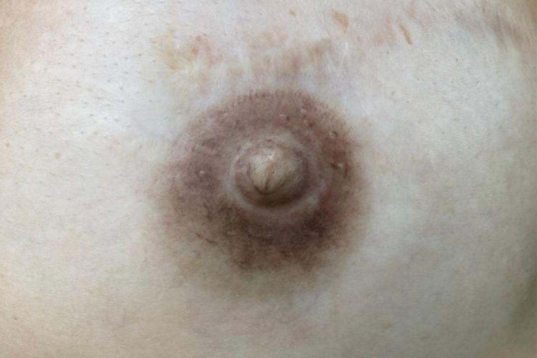 Micropigmentação Paramédica