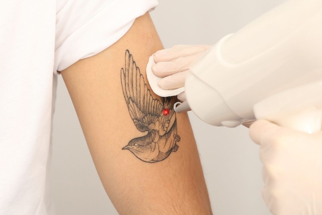 Remoção de Tatuagem